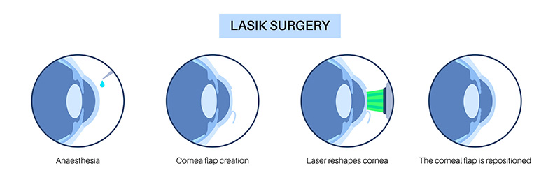 Diagram of the process of Laser Eye Surgery