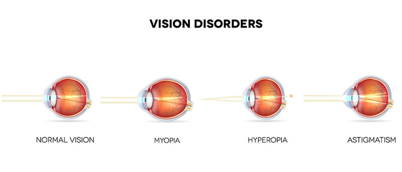 a diagram image of vision disorders
